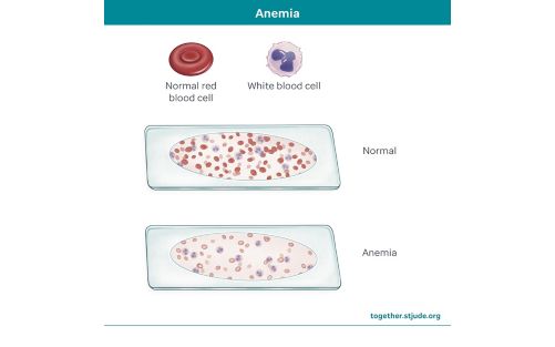 Medical illustration showing anemia 