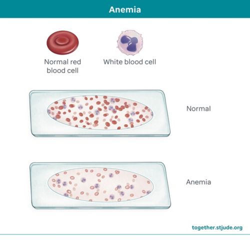 Illustration of anemia with normal red blood cells and anemic blood cells