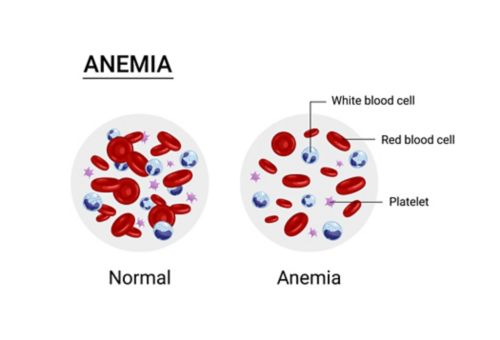 Anemia blood cell and normal blood cell graphic with white and red blood cells and platelets