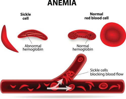 Sickle cell disease causes healthy red blood cells, which are round and soft, to become hard and shaped like a banana.
