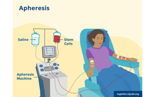 Illustration of girl undergoing apheresis treatment