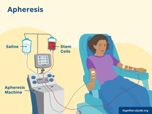 apheresis image showing saline bag, stem cells bag, apheresis machine