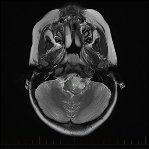 IRM en coupe axiale avec repères de taille pour un astrocytome