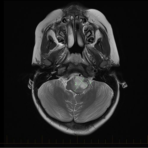 Axial MRI with size markings for an astrocytoma