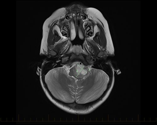 МРТ в осевой проекции с метками размеров астроцитомы