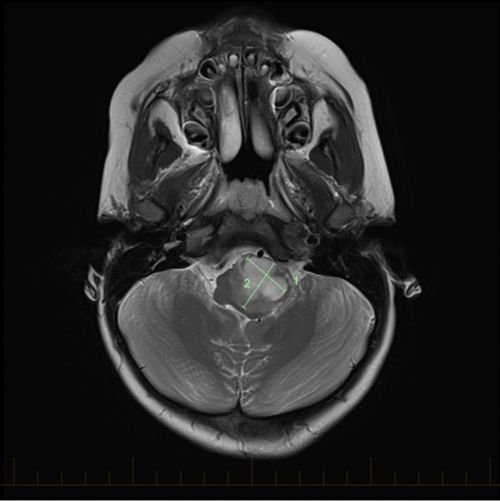 ایک آسٹروسائٹوما کے لیے سائز کے نشانات کے ساتھ ایکسیل MRI