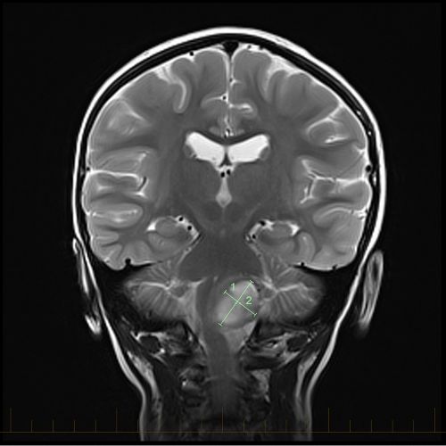 Coronal MRI with markings that show the size of an astrocytoma