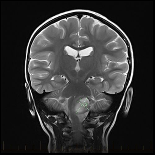 IRM en coupe coronale avec repères indiquant la taille d'un astrocytome