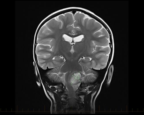 МРТ во фронтальной плоскости с метками для обозначения размеров астроцитомы