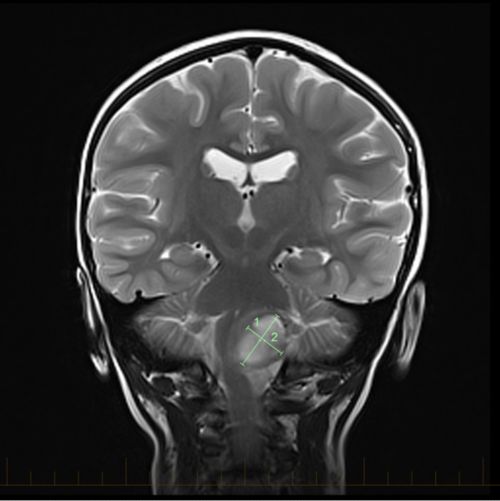 کورونل MRI نشانات کے ساتھ جو کسی آسٹروسائٹوما کی جسامت کی نشاندہی کرتا ہے