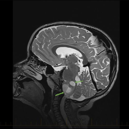 Les gliomes : diagnostic, classification, pronostic et traitement