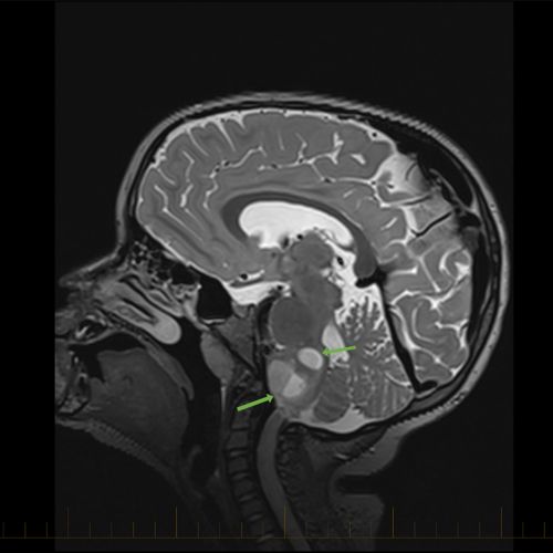 Sagittal MRI with arrows pointing to astrocytomas