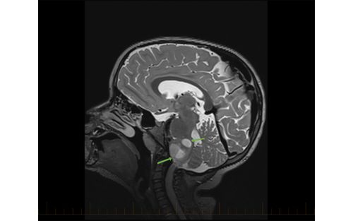 Brain scan with astrocytoma 