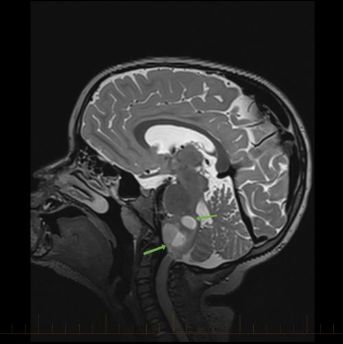 箭头指向星形细胞瘤的矢状位 MRI