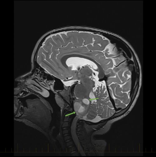 IRM sagital con flechas que apuntan hacia los astrocitomas
