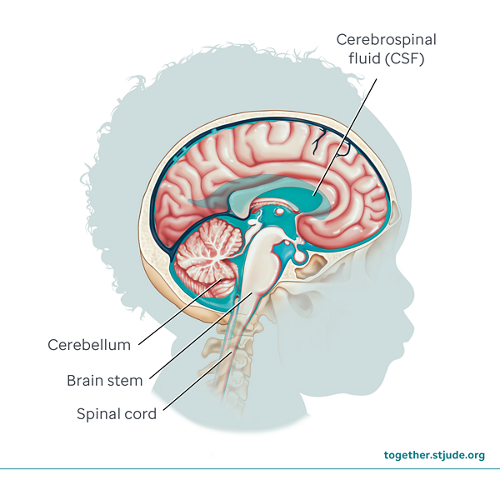 What is choroid plexus tumor? Choroid plexus tumors begin in the ventricles of the brain. Ventricles are spaces in the brain that are filled with cerebrospinal fluid. 