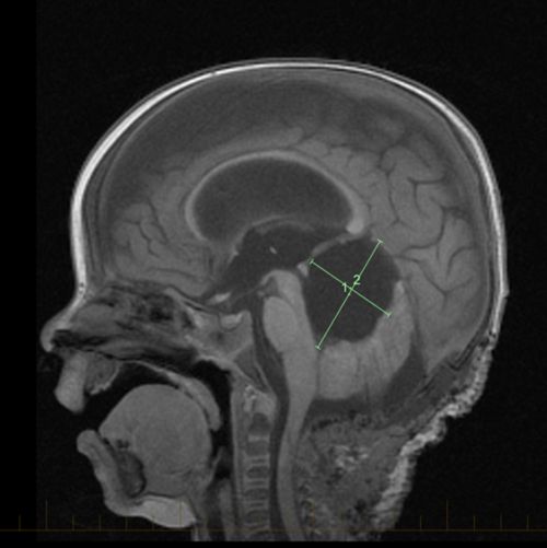Atypical Teratoid/Rhabdoid Tumor (AT/RT) is an aggressive and fast-growing tumor. Using magnetic resonance imaging (MRI), doctors can see the size and location of the tumor.