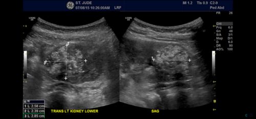 An ultrasound may be used to look for rhabdoid tumor of the kidney.