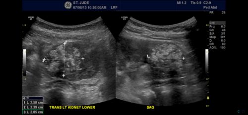 الٹراساؤنڈ گردے کے رابڈائڈ ٹیومر کی جانچ پڑتال کے لیے استعمال کیا جاسکتا ہے۔
