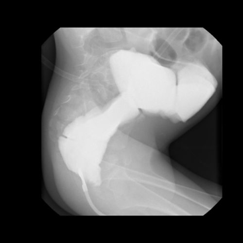 Vista lateral fluoroscópica de una prueba de serie de rayos X del tubo gastrointestinal (GI) inferior en un paciente de cáncer pediátrico.