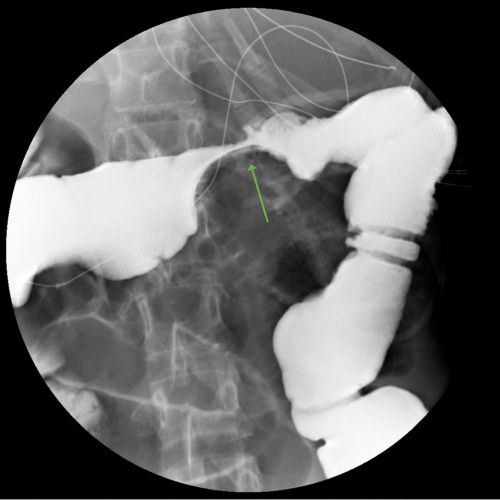 Una pequeña flecha verde apunta a una obstrucción en el tubo gastrointestinal inferior en una imagen de una prueba de serie de rayos X del tubo gastrointestinal (GI) inferior