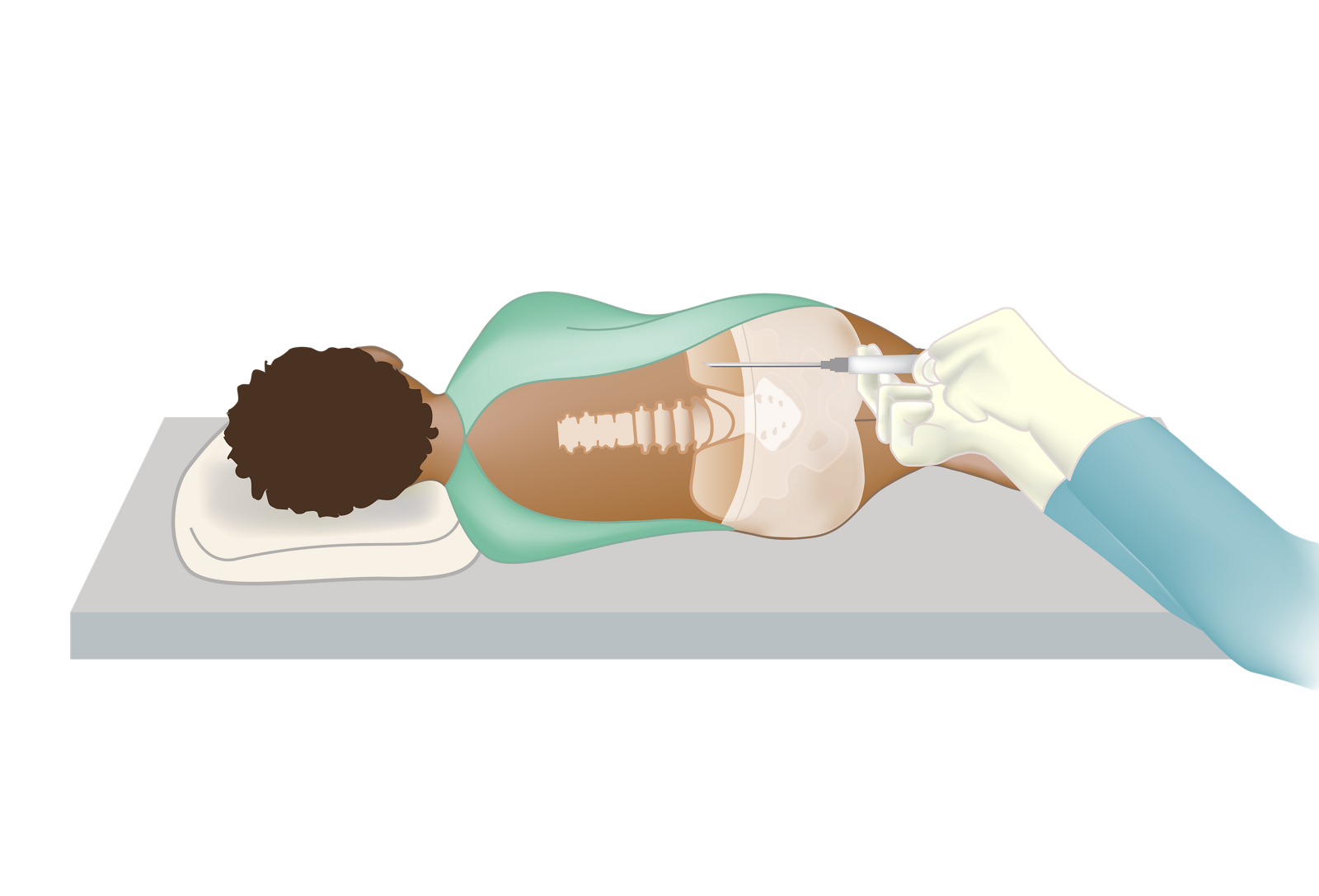 Пациент в положении лежа на боку с иглой, введенной в тазовую кость для проведения процедуры аспирации костного мозга