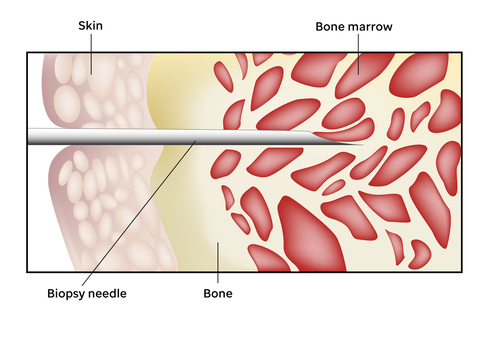 На изображении показана игла для биопсии, введенная через кожу в кость для взятия образца костного мозга