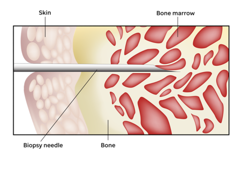 Illustration montrant une aiguille de biopsie insérée dans la peau et dans l'os pour prélever l'échantillon de moelle osseuse