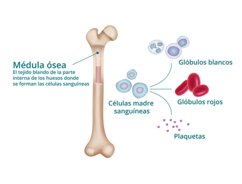 Células espumosas en aspirado de médula ósea en un paciente con