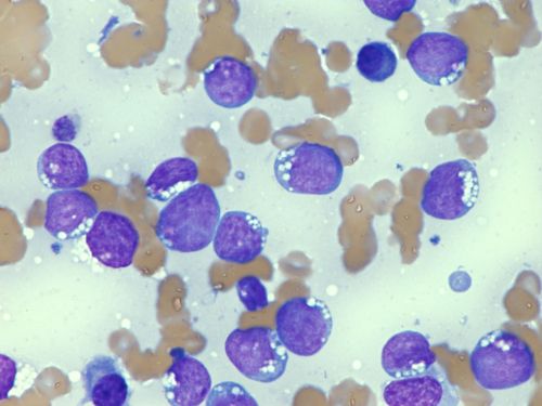 На ілюстрації показано два типи клітин під мікроскопом: один — здоровий лімфоцит, а інший — ракова клітина.