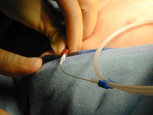 Esta imagem mostra a colocação de um dispositivo de acesso venoso central, frequentemente usado no câncer infantil.