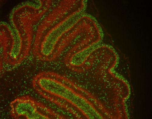 Image of medullablastoma 