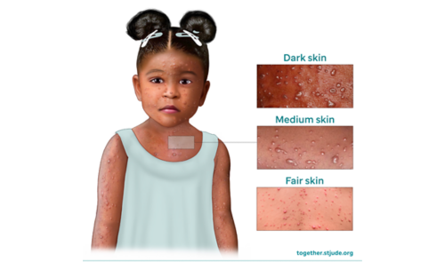 How chickenpox looks on dark, medium, and light skin