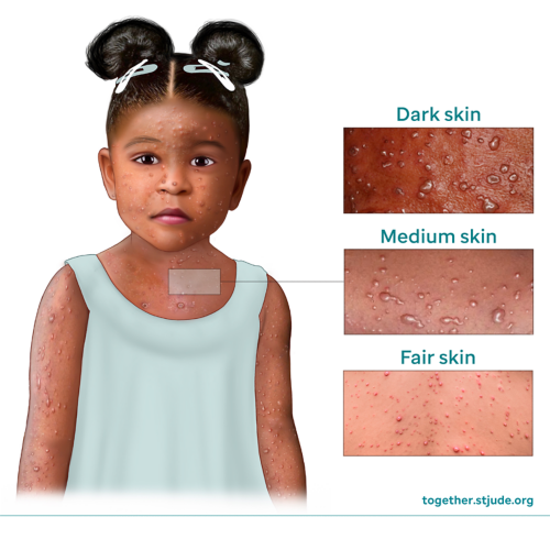 Chicken pox on dark skin, medium skin, and fair skin