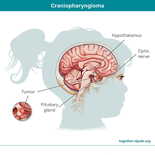 Craniopharyngiomas usually develop near the pituitary gland and hypothalamus. Tumors in this area affect endocrine function. If the tumor is near the optic nerve, vision may also be affected.
