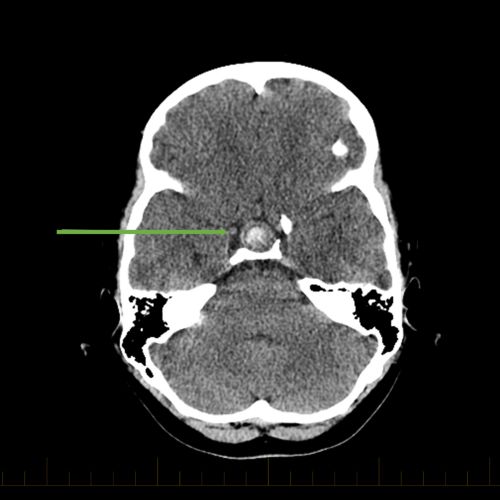 TC axial con flecha apuntando al craneofaringioma