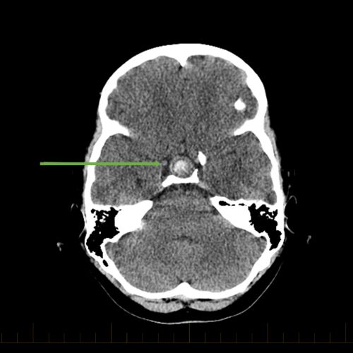 Tomodensitométrie axiale avec flèche pointant vers le craniopharyngiome