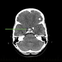 craniopharyngioma brain scan