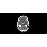 craniopharyngioma brain scan