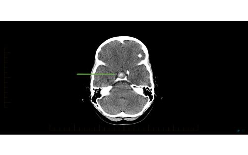 craniopharyngioma brain scan