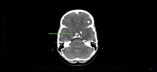 A CT scan may show cyst calcification, a common feature of pediatric craniopharyngioma.