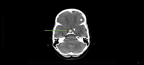  Craniopharyngioma brain scan