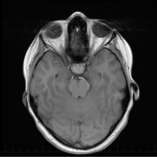 МРТ в осевой проекции с метками размеров краниофарингиомы