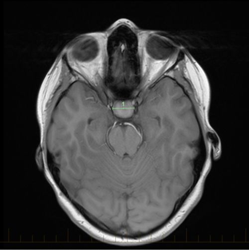 ဝင်ရိုး MRI က အရွယ်အစားအမှတ်အသားများနှင့်တစ်ကွ ဖော်ပြပေးနေသည့် ပီကျူထရီသန္ဓေသားကလာပ်စည်းမှဖြစ်လာသော ဦးနှောက်အကျိတ်