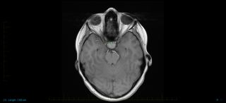 MRI scan with markings showing craniopharyngioma. Craniopharyngiomas usually develop near the pituitary gland and hypothalamus.