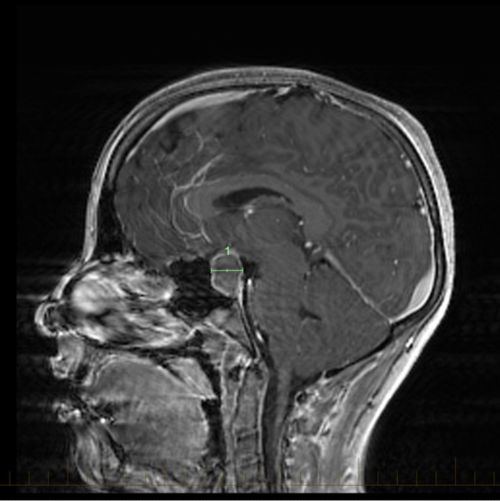 МРТ в сагиттальной плоскости с метками размеров краниофарингиомы