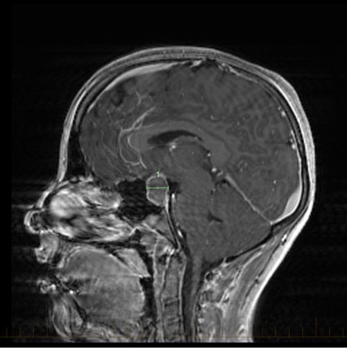 MRI scan with markings showing craniopharyngioma. Craniopharyngiomas are slow growing, but they can cause problems including abnormal hormone levels and vision changes.