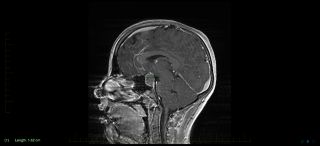 MRI scan with markings showing craniopharyngioma. Craniopharyngiomas are slow growing, but they can cause problems including abnormal hormone levels and vision changes.