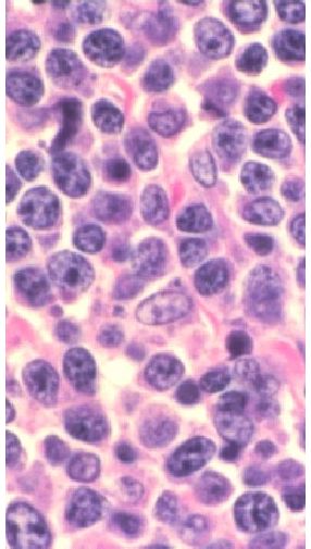 Diffuse large B-cell lymphoma as seen through a microscope.