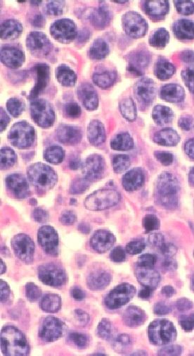 Diffuse large B-cell lymphoma as seen through a microscope.